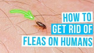 How to GET RID OF FLEAS ON HUMANS [upl. by Dido]