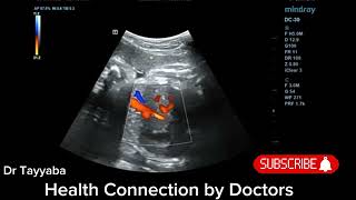 USG Ductus Venosus Doppler At 34 Weeks of Pregnancy  Health Connection by Doctors [upl. by Tigdirb]