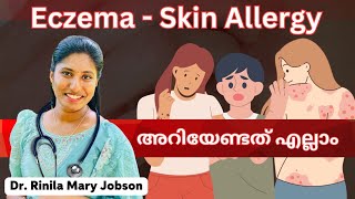 EczemaSymptoms and Natural Treatments  എക്സിമ  skin condition  Allergic reaction  Skin Allergy [upl. by Oliy]