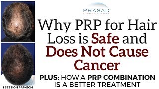 Why PRP for Hair Loss is Safe and Will Not Cause Cancer but a PRP Combination is a Better Treatment [upl. by Annuaerb]