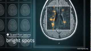 Multiple Sclerosis Understanding Your MRI [upl. by Llener46]