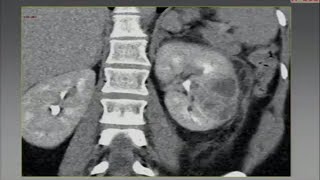 Benign Space Occupying Lesions of the Kidney Basic Radiology [upl. by Sadye]