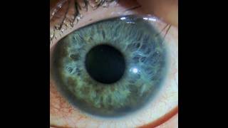 Uncontrolled IOP in an Eye with a Ciliary Body Melanoma 4 Months after Brachytherapy [upl. by Stier]