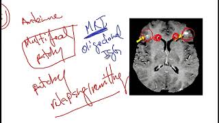 Video 217 Overview of Demyelinating Disorders Clinical Features Diagnostics and Risk Factors [upl. by Calvinna]