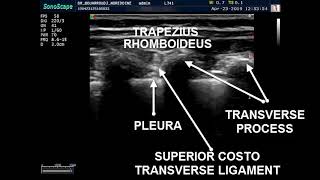 PARAVERTEBRAL BLOCK ULTRASOUND GUIDED [upl. by Gow]