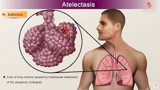 Atelectasis  Etiology Clinical Features Pathology pathophysiology Diagnosis and Treatment [upl. by Cinda]