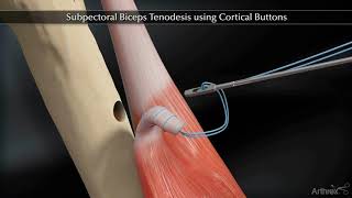 Subpectoral Biceps Tenodesis Using Cortical Buttons [upl. by Gudrin]