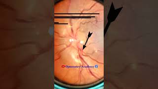 Tortuous Retinal vessels  Fundus Photography  Short Video 109 optometry optometrist [upl. by Galvan]