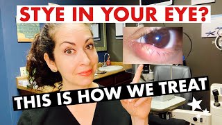 STYES  What are they and how are they treated  The Eye Surgeon [upl. by Neiviv462]