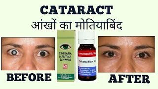 CATARACTआँखों का मोतियाबिंद HOMOEOPATHIC TREATMENT [upl. by Firestone]