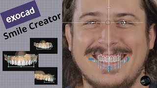 Exocad  Smile Creator [upl. by Lose]