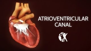 Atrioventricular Septal Defect  AV Canal [upl. by Rapp816]