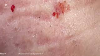 Big Cystic Acne Blackheads Extraction Blackheads amp Milia Whiteheads Removal Pimple Popping [upl. by Lilahk]