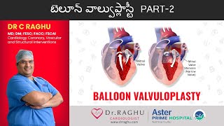 Which one is better  Balloon Valvotomy or Valve replacement  Dr C Raghu [upl. by Joao]