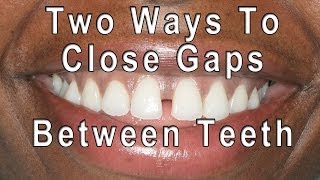 How to Close Gaps Between Teeth [upl. by Jonas374]