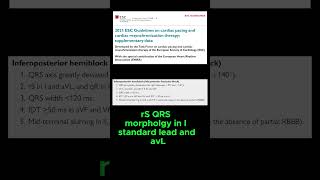 ECG criteria of LEFT POSTERIOR FASCICULAR BLOCK [upl. by Erline]