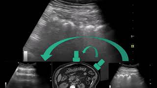 Pneumoperitoneum Signs  Point of Care Ultrasound [upl. by Ainer]