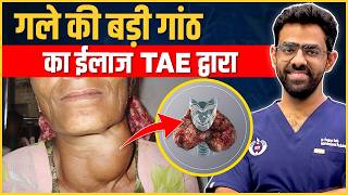 गले की गांठ ज्यादा बड़ी है तो Thyroid Artery Embolization TAE द्वारा बिना ऑपरेशन ईलाज संभव [upl. by Lamaaj]