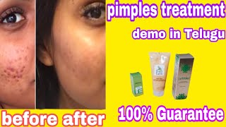 Modicare Pimples treatment demo in Teluguorganic productsGood results100Guarantee pimples remove [upl. by Morra107]