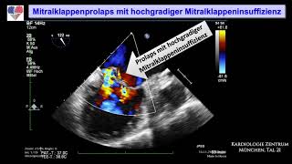 „Ausbuchtung“ Prolaps eines Mitralsegels [upl. by Ohce]