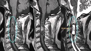 Spinal Masses  Location Intramedullary Ependymoma [upl. by Tezile]