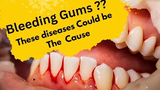 Why Your Gums Are Bleeding Causes of Bleeding Gums [upl. by Ydnim]