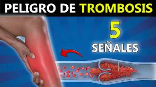 Peligro de TROMBOSIS cuales son las Señales [upl. by Woothen]