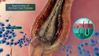 Human Smart Exosomes in action  Regenera Activa Autologous Micrografting Hair Treatment [upl. by Libnah]