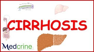 LIVER CIRRHOSIS causespathophysiologyfeaturesdiagnosistreatment [upl. by Corso166]