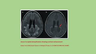 Neurology Quiz 91 Adrenoleukodystrophy [upl. by Naimerej]