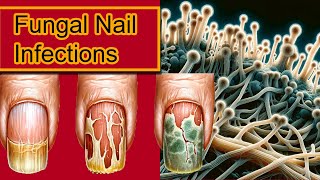 Understanding Onychomycosis Nail Fungal Infection Treatment [upl. by Blondelle497]