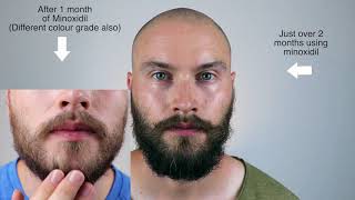 MINOXIDIL BEARD JOURNEY  2 Month Update [upl. by Titus]