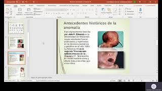 Sindrome de Edwards o Trisomia 18 [upl. by Niac]