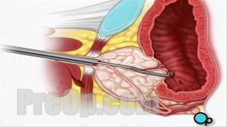 TURP Transurethral Resection Prostate Surgery patient education series [upl. by Ebanreb144]