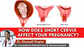 How does Short Cervix affect your pregnancy  Causes Diagnosis amp Treatment  Healing Hospital [upl. by Adnalue]