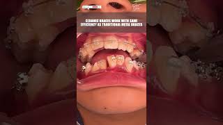 Ceramic Dental Braces Fixing Process  dentalbraces braces invisiblebraces orthodontictreatment [upl. by Phox]