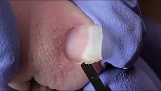 Ingrown Toenail Removal  Pedicure Treatment and Very Satisfying  Best Satisfying Nail Cutting [upl. by Adelind695]