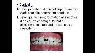 supernumerary teeth [upl. by Ellesirg]