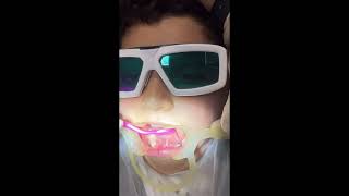 Lingual frenectomy with diode laser epic 10biolase companyby Dr Ali Heidari [upl. by Elmira742]