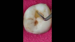 How to find cavity in teethTeeth recontractiontooth Carries cavitiesteeth talk girldentistry [upl. by Aleron948]