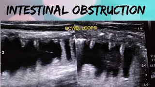 Intestinal Obstruction Ultrasound  Intestinal Health  Constipation [upl. by Sirej536]