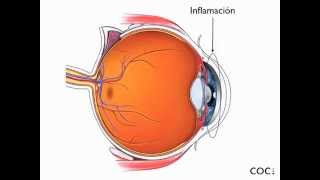 Tipos Uveitis coc [upl. by Nallaf634]