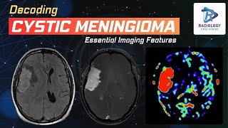 Decoding Cystic Meningioma  Dr Umamaheswara Reddy V [upl. by Oiramel]