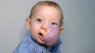 See 2YearOlds Incredible Transformation After Surgery To Remove Facial Tumor [upl. by Eilegna]