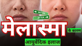 Natural Melasma Remedies Ayurvedic Treatments for Clear Glow [upl. by Nicolai]