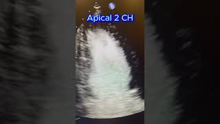 Regional Wall Motion echocardiography [upl. by Richara]