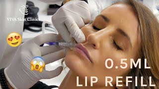 05ML LIP REFILL  NATURAL LOOKING FULL LIPS  LIP FILLERS  VIVA Skin Clinics [upl. by Inafetse]