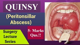 Peritonsillar AbscessQuinsy Surgery Lecture NEET PG Aspect in Tonsils Tonsillitis [upl. by Ingrid504]