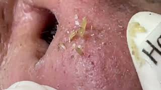 Nose Blackheads Removal with Haris Beauty  2022 [upl. by Erdah910]