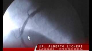 DR ALBERTO LICHERI  STENT COLOCACIÓN SANTA FE  ARGENTINA [upl. by Nwahs918]